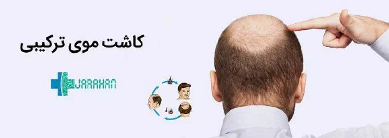 کاشت مو به روش ترکیبی چیست؟